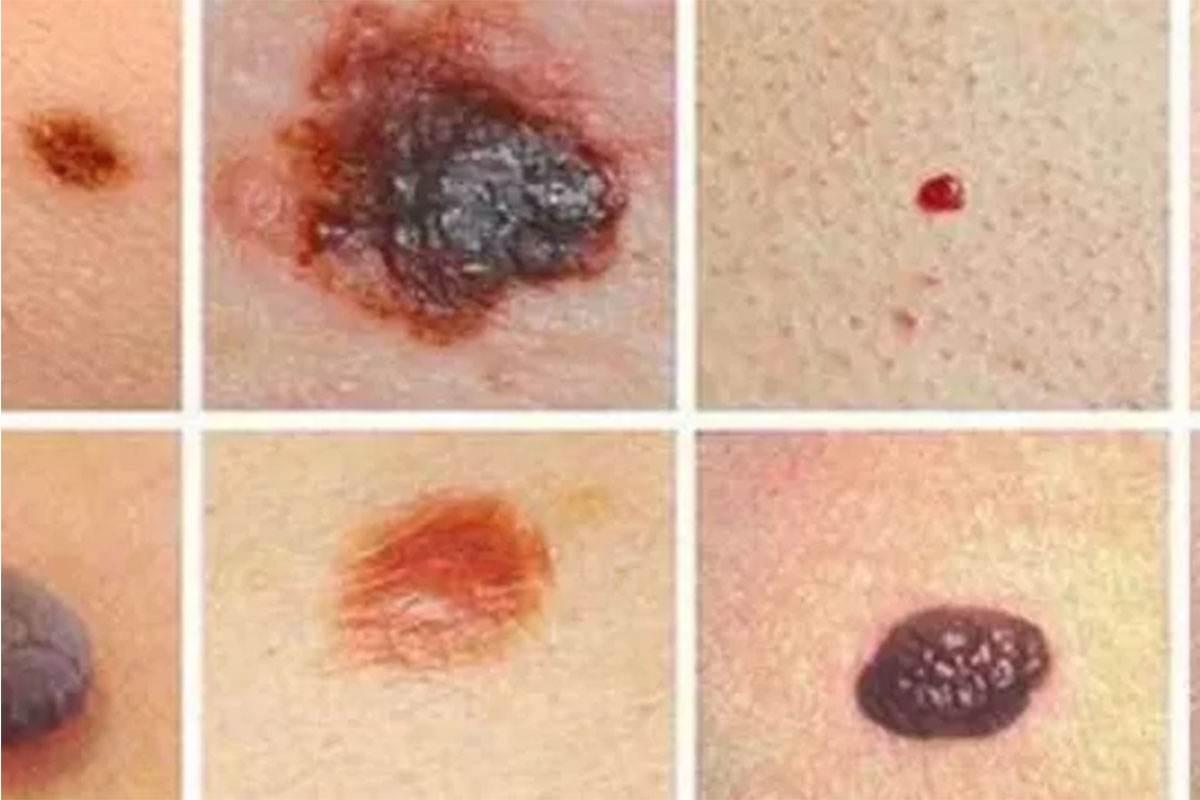 Thuốc mới giúp làm giảm 58% nguy cơ tử vong do ung thư hắc tố ác tính