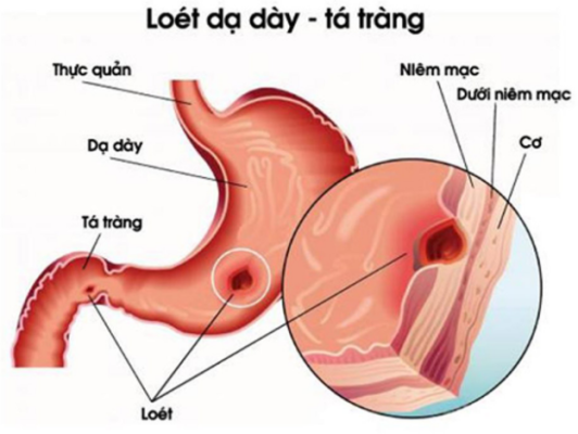 Thuốc trị viêm loét dạ dày tá tràng